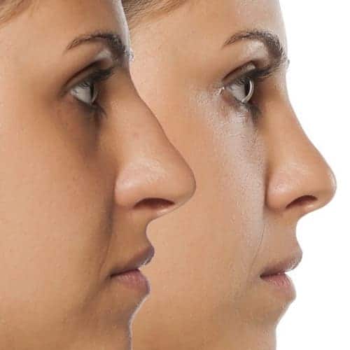rhinoplastie chirurgie esthetique visage paris chirurgien maxillo facial docteur charles mathieu bandini paris 17